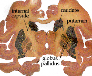 Basal ganglia in cadaver material
